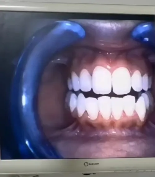The practice's intraoral camera screen showing a patient's front teeth, held open by a blue retractor.