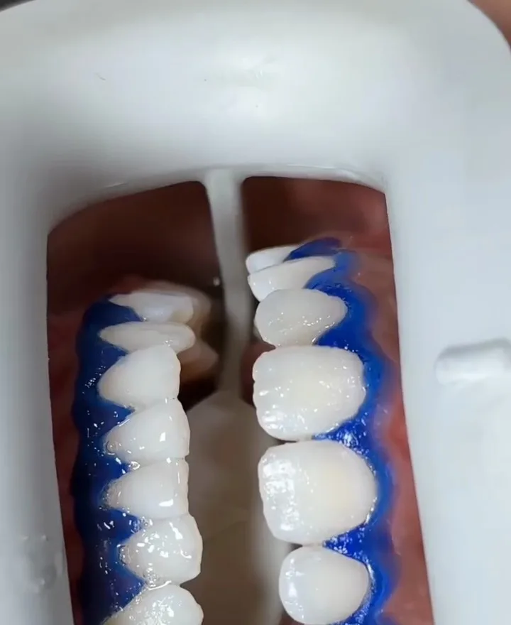 Teeth held open by a cheek retractor, gums covered with a blue protective gel before in-chair whitening.